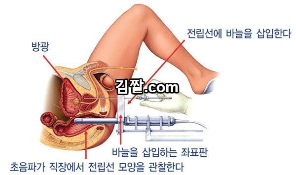 전립선.jpg